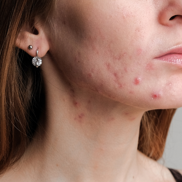 6 Reasons Why Regular Facials Are Essential for Acne-Prone Skin