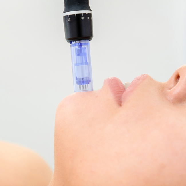 Exploring the Benefits of Microneedling for Skin Renewal, Visible Results Pawleys Island South Carolina