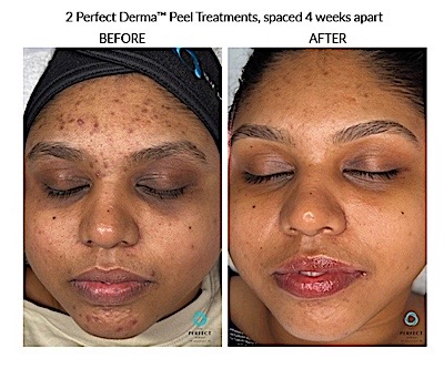 before_011025_001 The Perfect Derma Peel Pawleys Island Visible Results